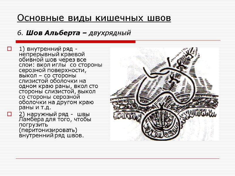 Основные виды кишечных швов 6. Шов Альберта – двухрядный  1) внутренний ряд -